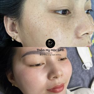 Điều trị tăng sắc tố da