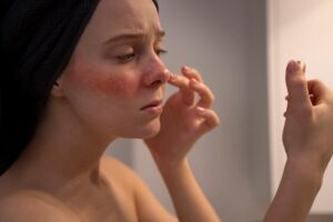 Phục Hồi Da Nhiễm Corticoid – Giải Pháp Chuyên Sâu và An Toàn